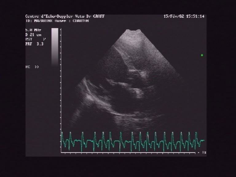 Echo BD d'une cardiomyopathie dilate. Le ventricule gauche est dilat et les parois fines.